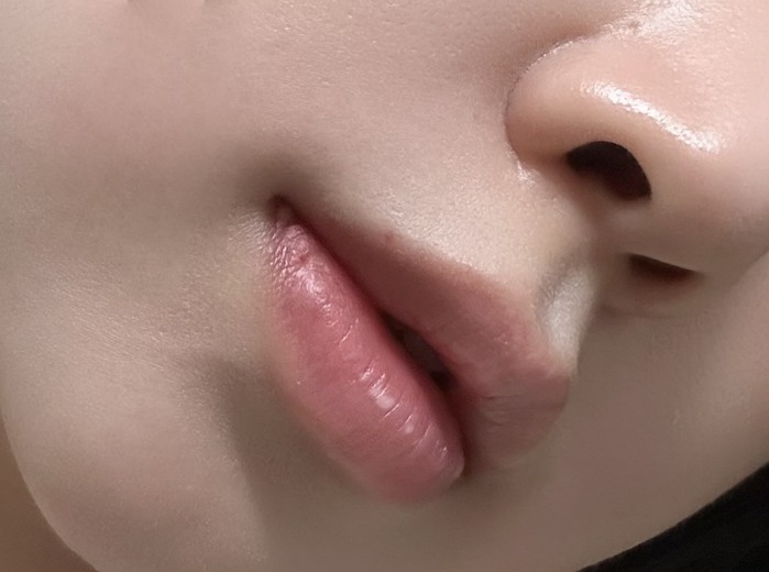 after photo: 입꼬리필러, 입술필러