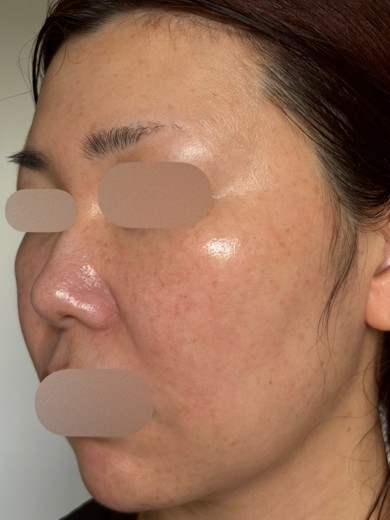 after photo: IPL(光/フォト治療), ルメッカ