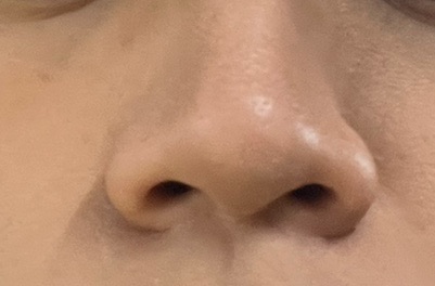 2023年最新エレクトロポレーション ハイドラフェイシャル 2023年最新