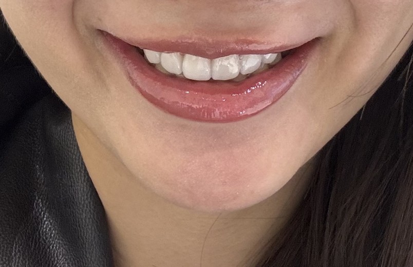 after photo: 라미네이트