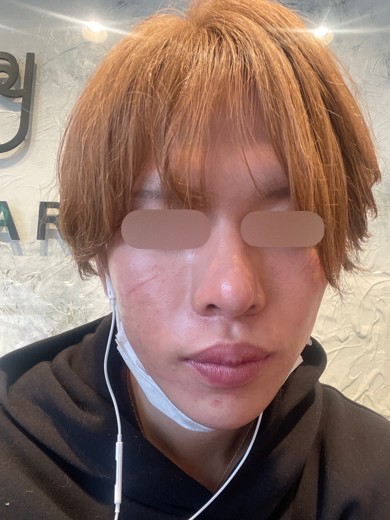 after photo: ダーマペン