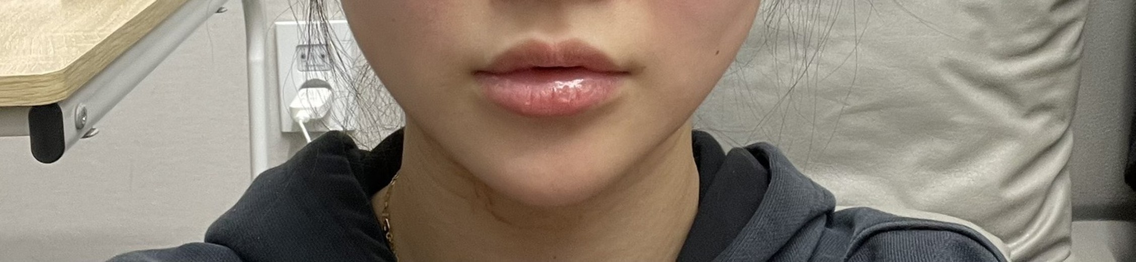 after photo: 인모드리프팅