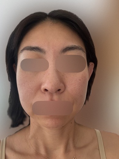 after photo: ウルトラフォーマー3(ハイフ)