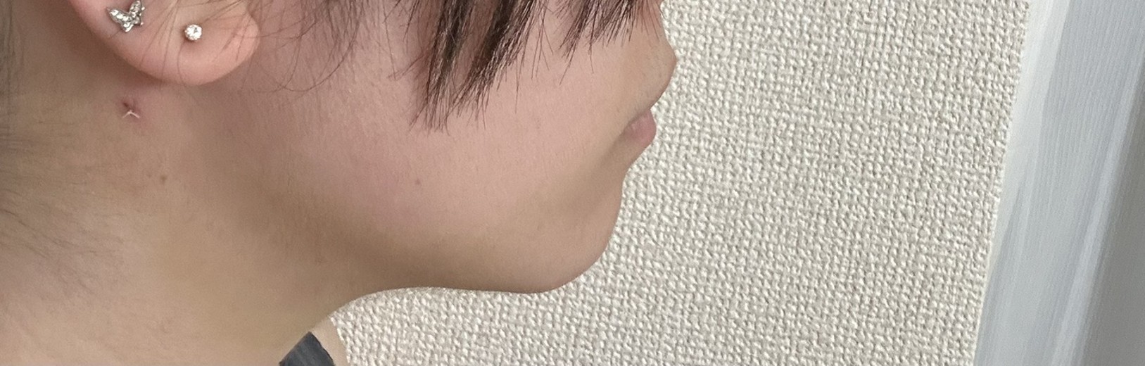 after photo: 脂肪吸引(顎下)
