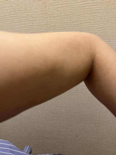 after photo: 脂肪溶解注射(腕)