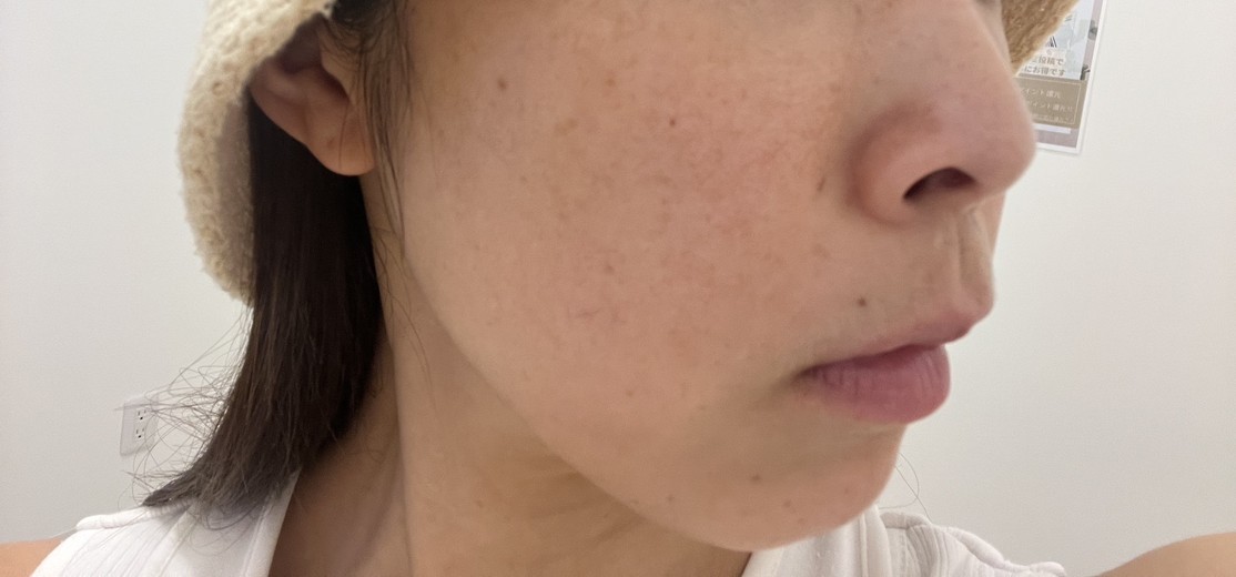 before photo: ピコトーニング, ピコフラクショナル