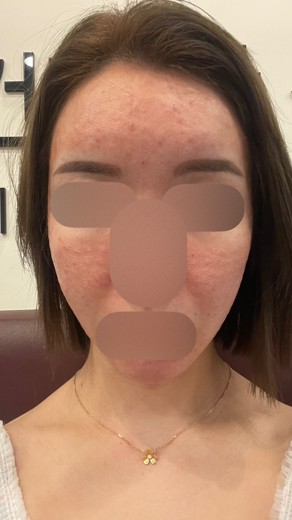 before photo: 糸リフト