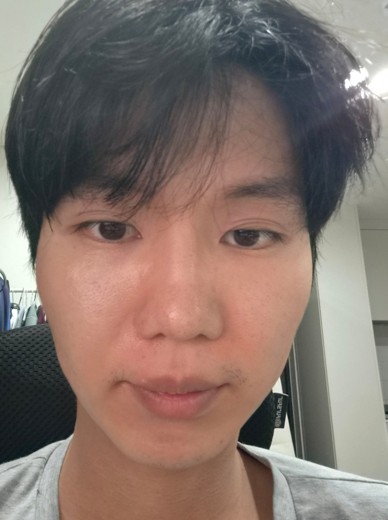 before photo: 턱제모, 인중제모