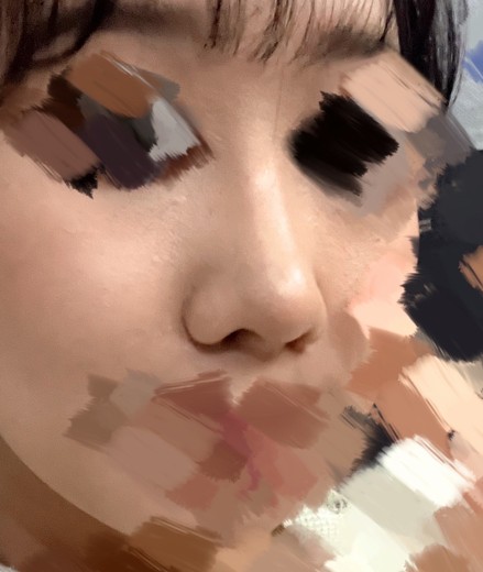 after photo: 콧대(자가조직), 코끝(자가연골)