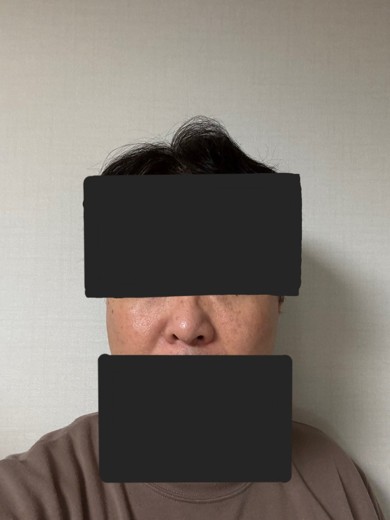 after photo: 눈밑지방재배치