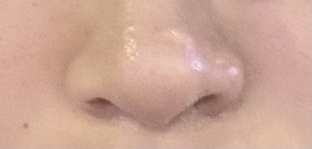 after photo: 콧볼축소