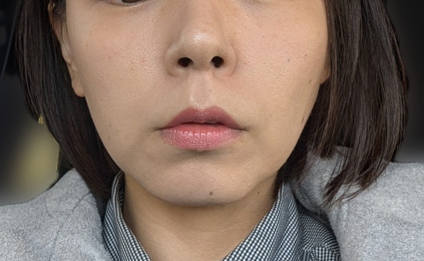 after photo: ハイフ(HIFU)
