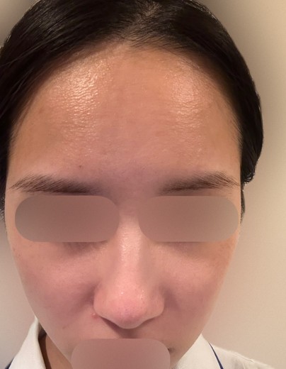 after photo: 水光注射