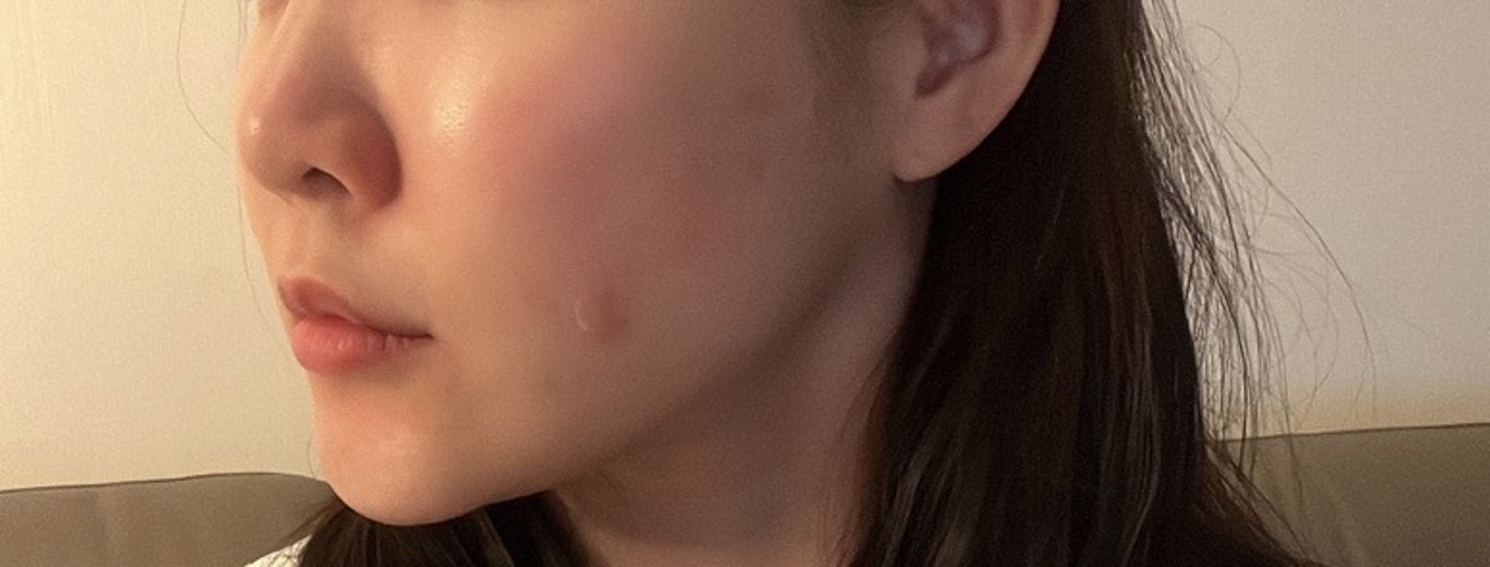 after photo: PRP피부재생술