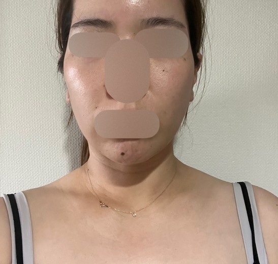 after photo: エラボトックス, 肩ボトックス(僧帽筋)
