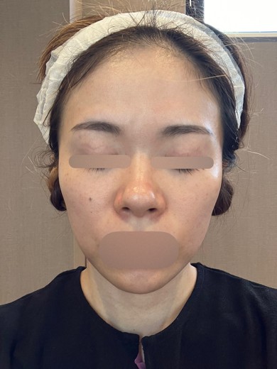 after photo: ピーリング, ルメッカ