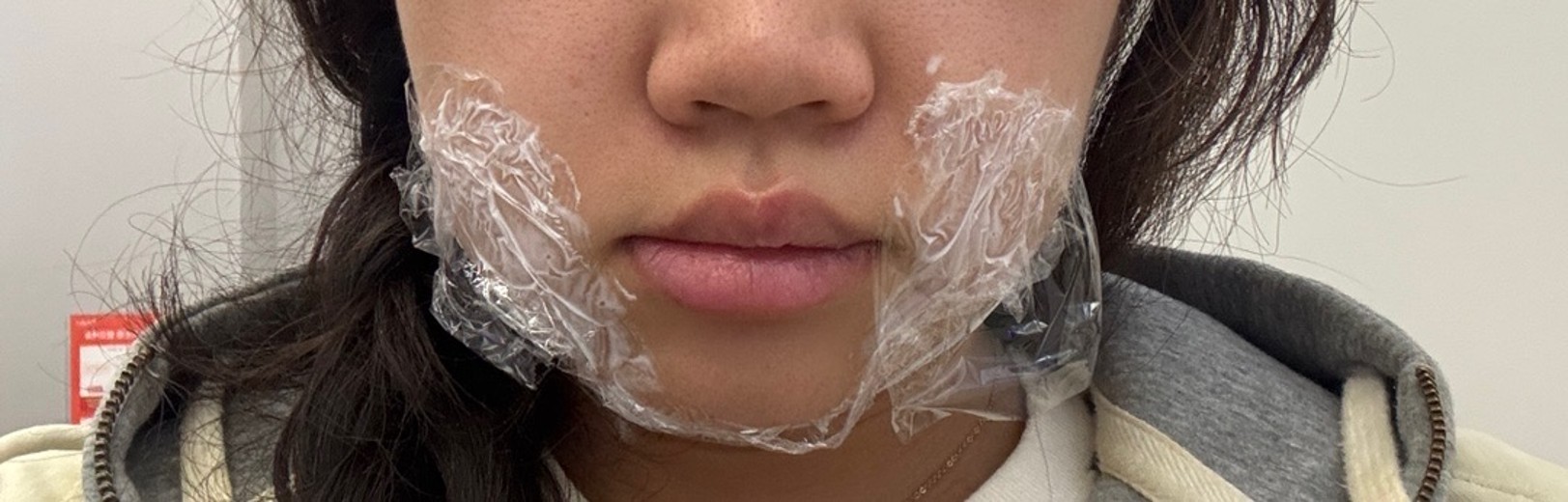 before photo: 윤곽주사, 얼굴지방분해주사