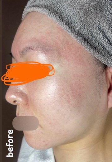 before photo: ダーマペン