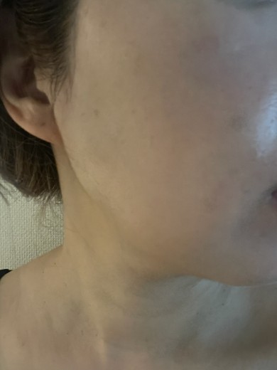 after photo: サーモン注射