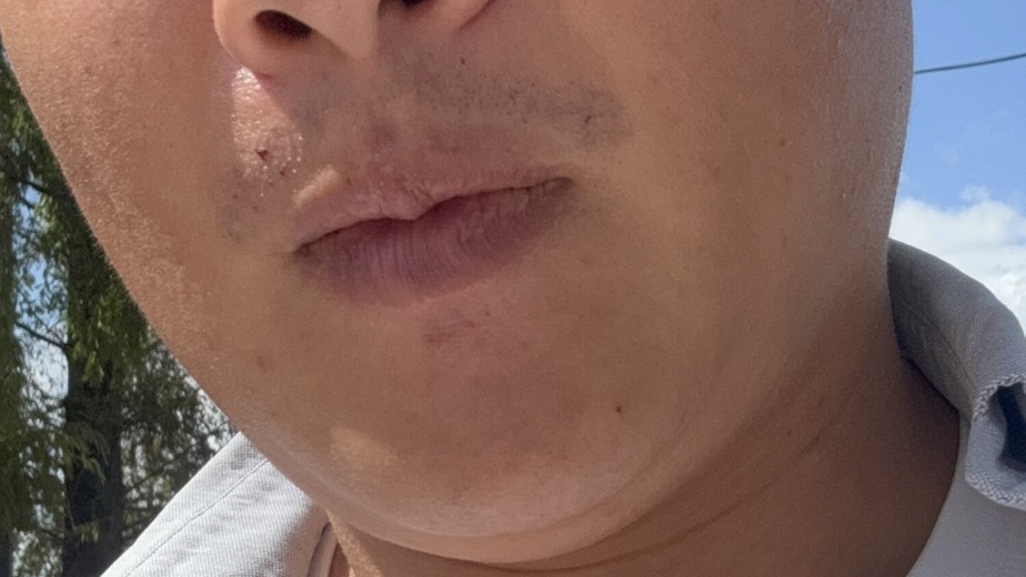 before photo: 턱제모