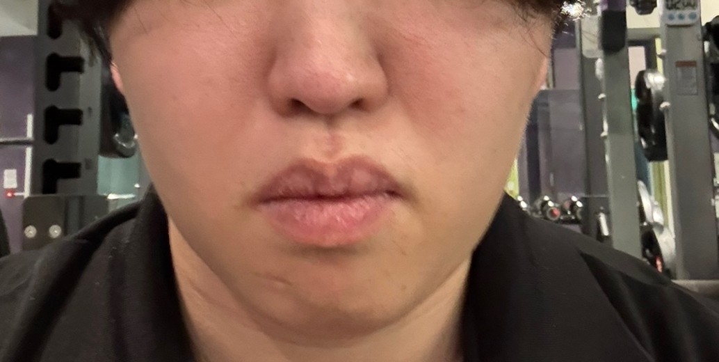 after photo: 脂肪溶解注射(顔)