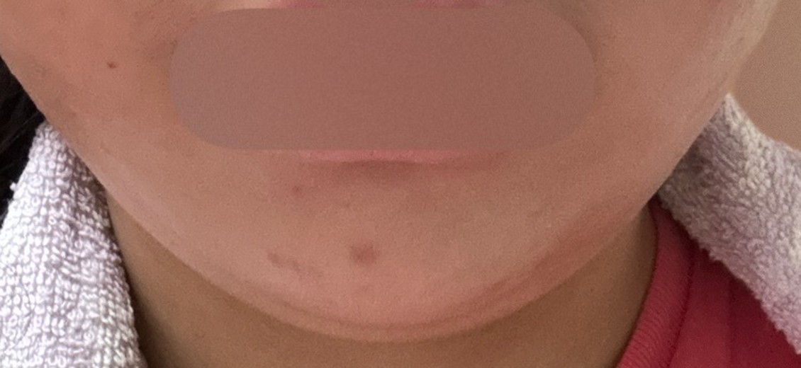after photo: 脂肪溶解注射(顔)