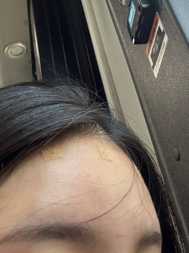 after photo: 이마필러