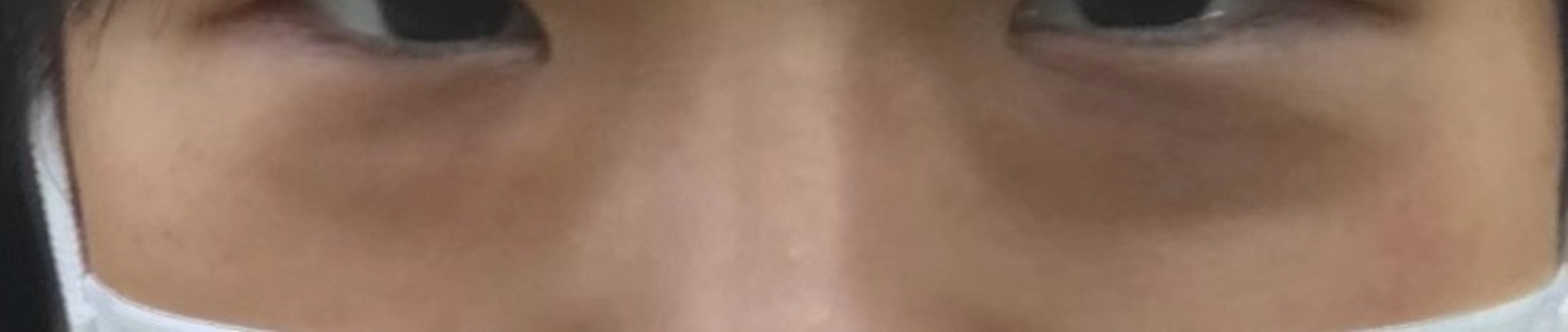 before photo: 目の下脂肪再配置(ハムラ・裏ハムラ法)