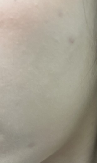 after photo: 피코토닝, 제네시스