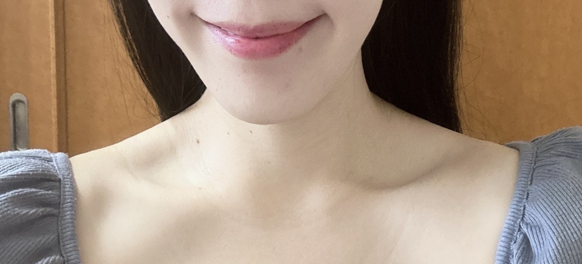 before photo: 小じわボトックス