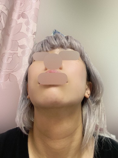 after photo: 首・広頚筋ボトックス