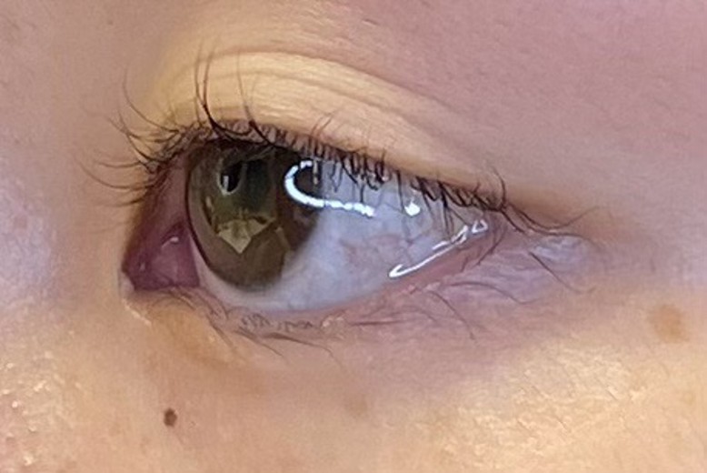 before photo: 目尻切開