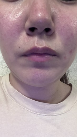 after photo: 診断・検査, ジュベルック(Juvelook)