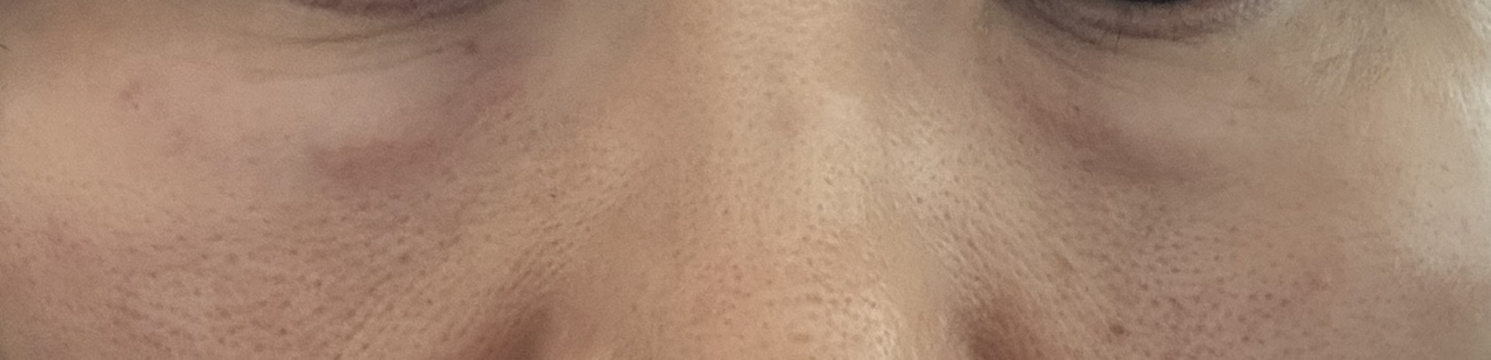 after photo: 리쥬란아이