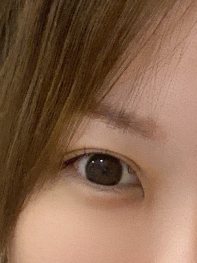 before photo: あごヒアルロン酸, 涙袋ヒアルロン酸