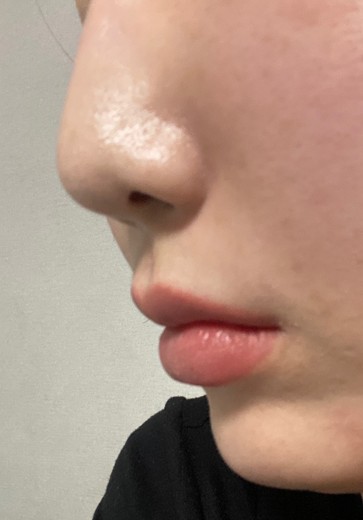 after photo: 앞광대필러