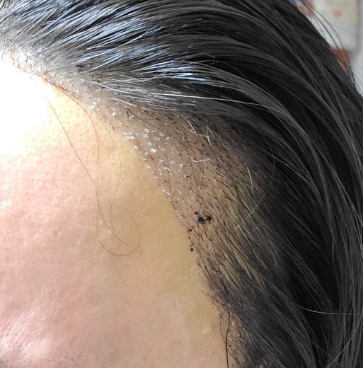 after photo: 머리모발이식