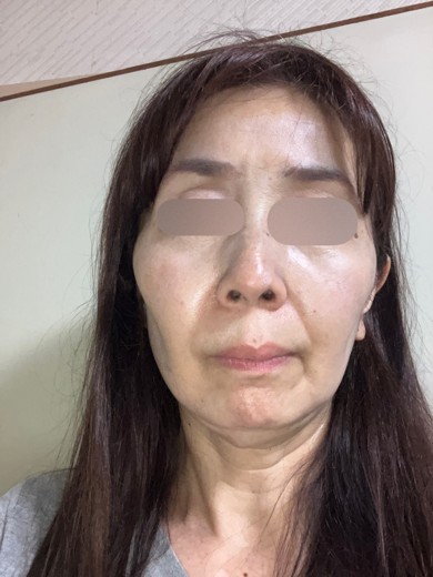 after photo: エレクトロポレーション