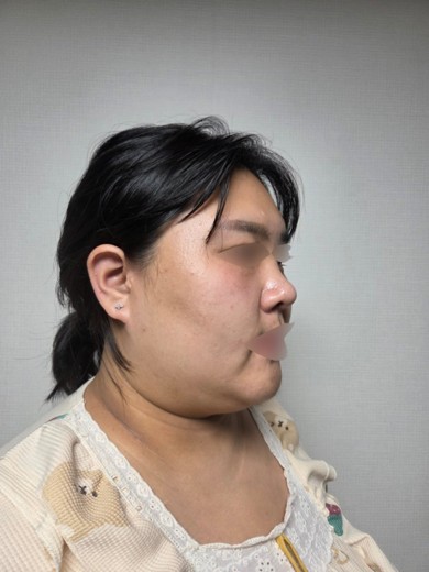 after photo: 비중격만곡증수술, 코끝(보형물)