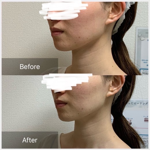 after photo: チタニウムリフト
