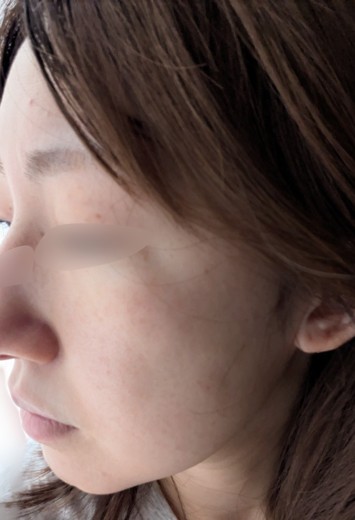 after photo: IPL(光/フォト治療), ピーリング