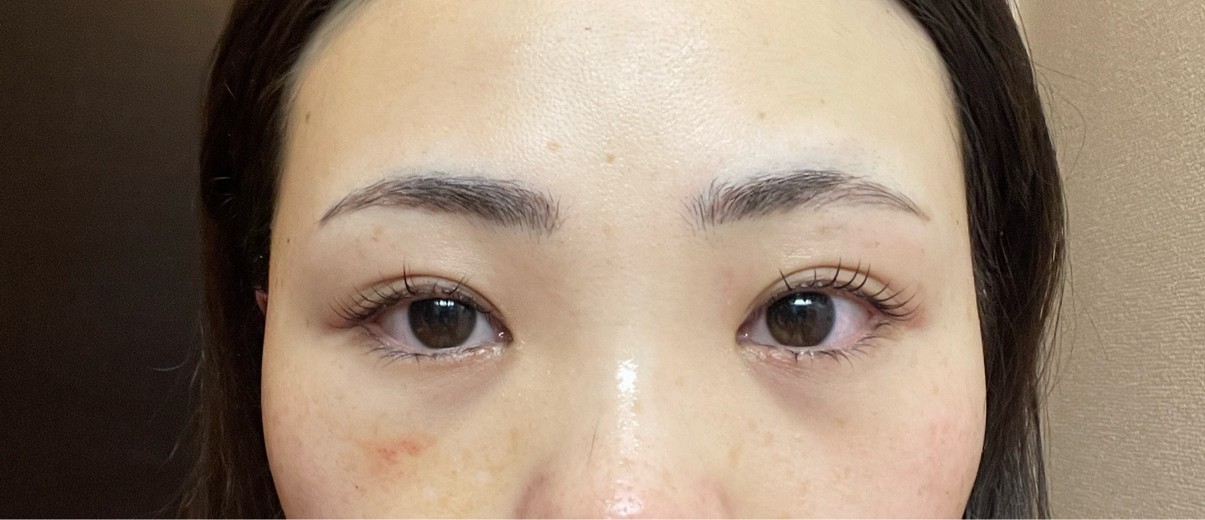 after photo: 脱脂(クマ治療)