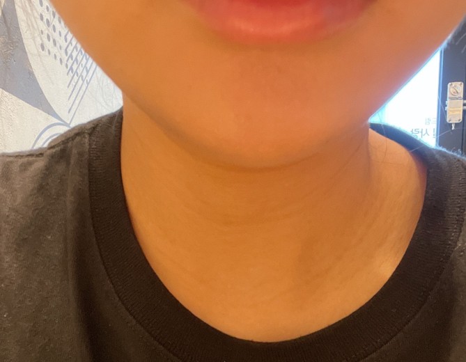 after photo: 인모드리프팅