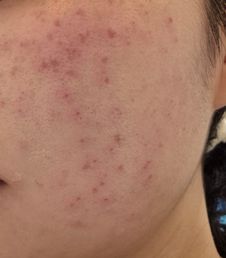 after photo: 레이저토닝