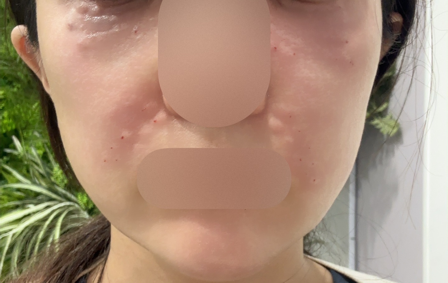 リジュラン 2cc | Karis Beauty Clinic