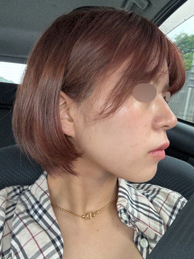 before photo: 脂肪溶解注射(顔)