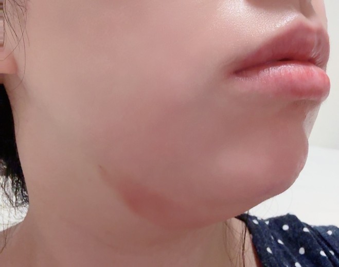 after photo: 脂肪溶解注射(顔)