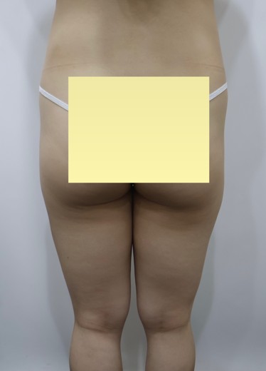 before photo: 허벅지지방흡입