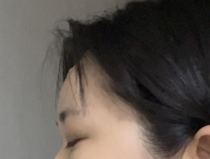 after photo: 이마필러