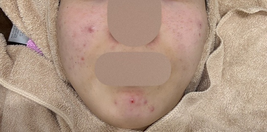 before photo: IPL(光/フォト治療), ピーリング, エレクトロポレーション, ルメッカ